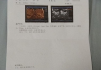 上个月检查出有多囊我今天去检查B超结果是正常