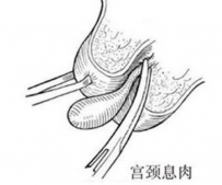 子宫息肉怎么治疗必须手术吗?子宫息肉的最佳治疗方法什么