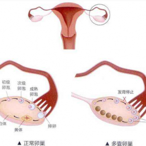 什么是子宫畸形