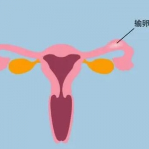 输卵管积水能自然怀上孩子吗？
