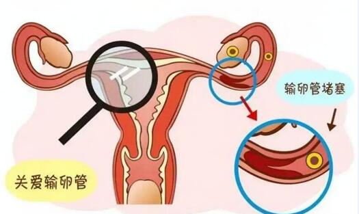 怎么证明输卵管是通的?附输卵管自测9种方法分别是什么?