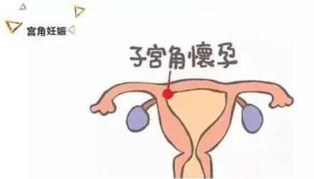子宫畸形可以自然怀孕吗?哪种子宫畸形更严重?