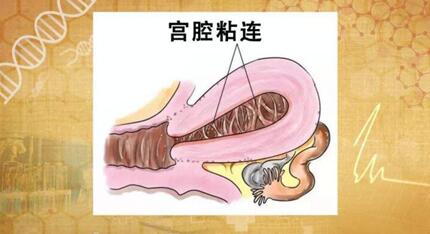 宫腔粘连是什么原因造成的?宫腔粘连的四大原因!