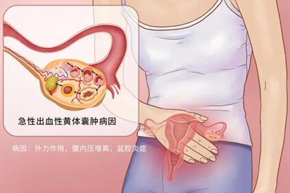 黄体囊肿一般多久会消失?黄体囊肿了怎么办?