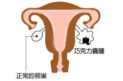 巧克力囊肿会导致不孕吗?巧克力囊肿可以做试管吗?