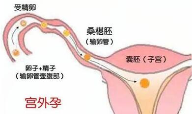 输卵管堵塞怎样避免宫外孕?