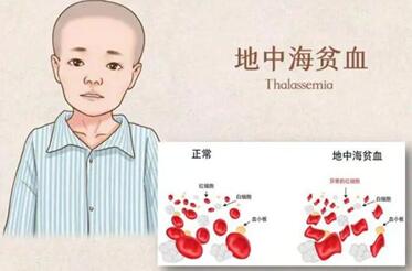 地中海贫血不只是贫血那么简单,试管婴儿能筛选地贫基因吗?