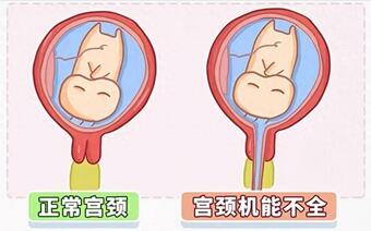 宫颈扩张术后注意事项,用好这些措施才能确保短时间内不再复发