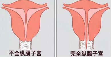 纵膈子宫多少厘米要手术?纵隔子宫有什么危害吗