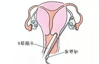 取卵穿过子宫如何应对?取卵穿过子宫有什么危害