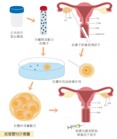 什么样的人适合试管婴儿?
